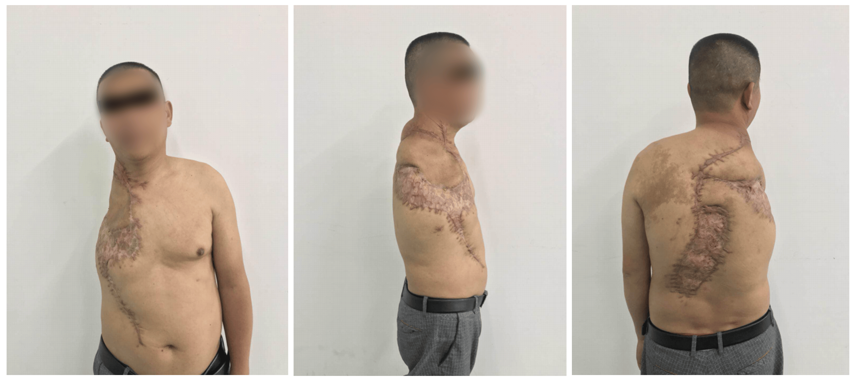 Combined Pedicled Trapezius Flap With Negative Pressure Wound Therapy